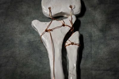 Bone sculpture with broken bones wrapped in copper wire. Words written on the larger unbroken bone: We are all an amalgamation of the good and bad that happen to us.